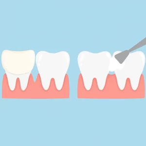 Side-by-side comparison of two dental procedures:, Veneers vs. Bonding.