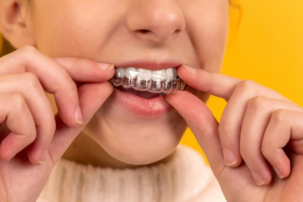 Close-up of a person inserting a clear dental aligner, showing how different Types of Mouthguards can protect and support teeth during orthodontic treatment.
