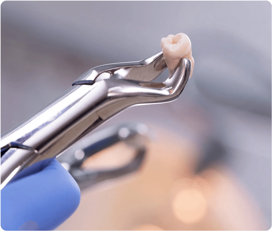 Tooth Extraction img
